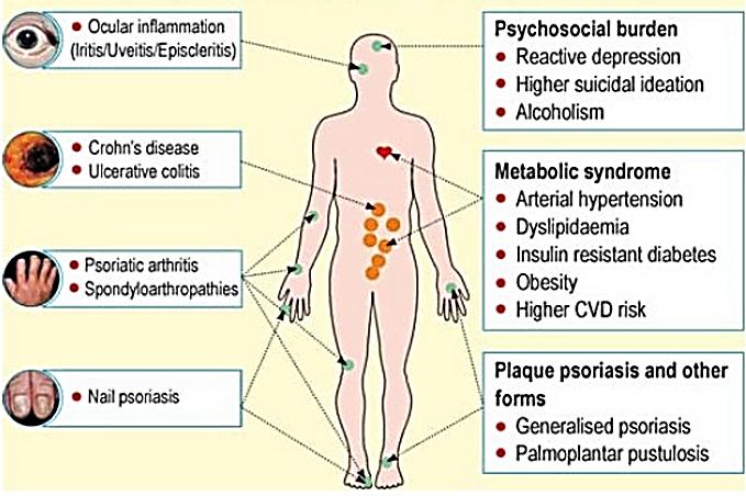 Co-morbidities in Psoriasis