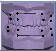 2) Apical base To examine whether the expected increase in arch width was bodily or tipping tooth movement, each tooth has measured in three regions: -Occlusal values -Gingival values -Alveolar