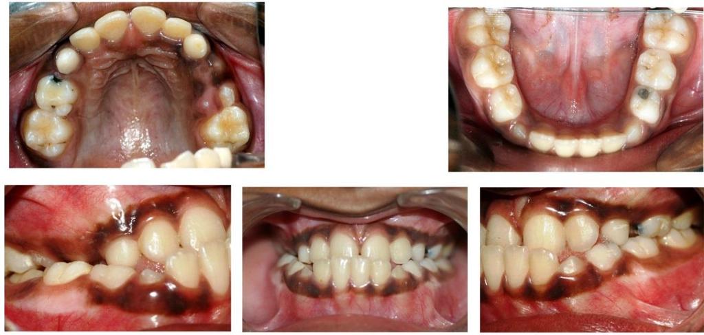 Pre-treatment intra oral view