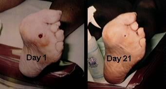 Diabetic Foot Ulcer Diabetics are prone to foot ulcerations due to