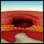 The ulcer presents clinically as a