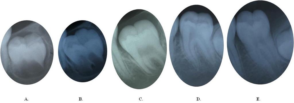 Fig. 2 Fig. 2: Development stages of mandibular left second molar: There were staged according to the calcification stages put forth by Demirjian et al.