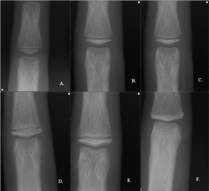 3: Developmental stages of middle phalanx of the third finger: For radiographic interpretation of MP3 stages, (E3/4) stage (Leite et al (8) ) was added in Hägg and Taranger s (9,10) method of MP3