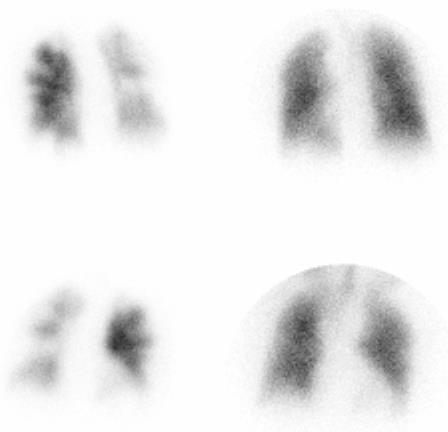 Lung Scintigraphy (V /Q )