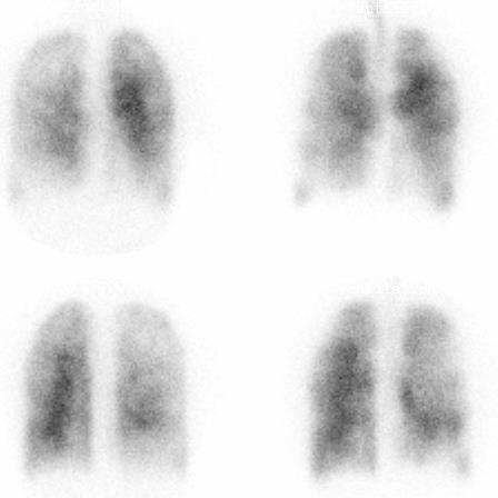 Lung Scintigraphy