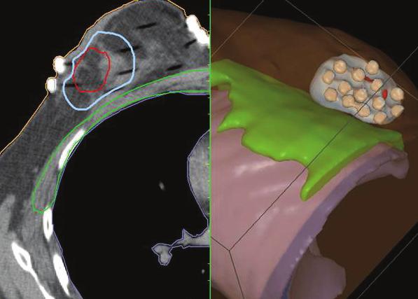 Breast brachytherapy techniques: applying technical advances Breast brachytherapy devices aim to achieve conformal dose coverage of the tumor site, high dose homogeneity, and a rapid dose fall-off
