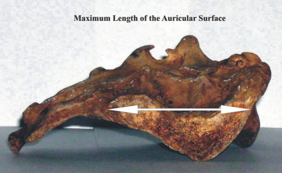 155 SEX DIFFERENCES IN SACRA IN THE PUNJAB REGION postero-superior border of the first sacral vertebral body, the maximum possible diameter of first sacral vertebra was measured by using the radial