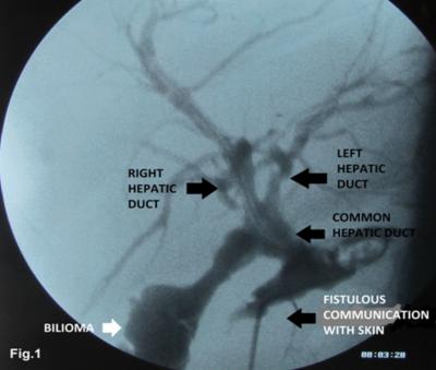 Figure 1 Fig. 1: Fistulogram showing communication of biliocutaneous fistula with common hepatic duct and distal common bile duct obstruction with bilioma stricture of the common bile duct.