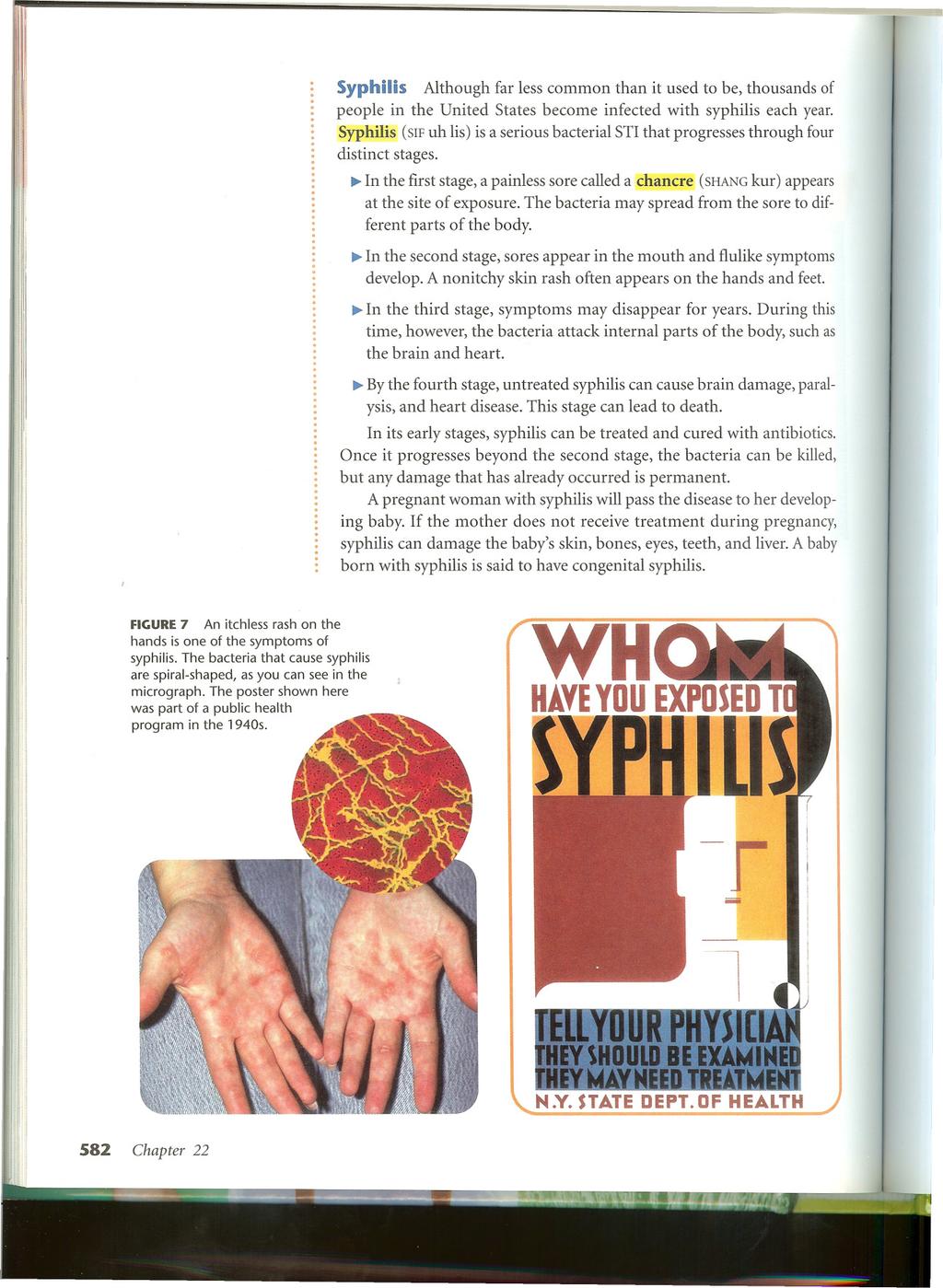 Syphilis Although far less common than it used to be, thousands of people in the United States become infected with syphilis each year.