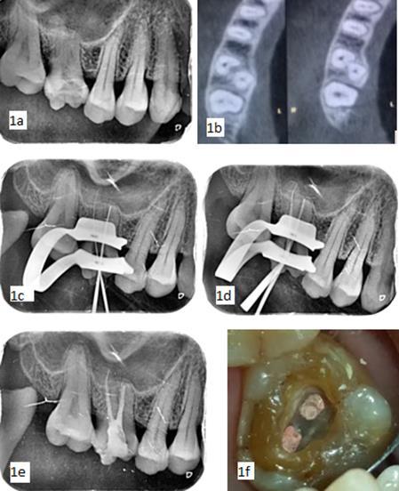 the IOPAR only two root outlines were evident. A diagnosis of symptomatic apical periodontitis was made and root canal therapy was decided on as the definitive treatment option.