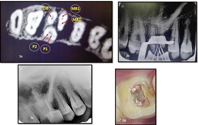approximately 2 mm from the MB orifice in a palatal direction. At the same time a similar hemorrhagic point was noted near the orifice of the main palatal canal.