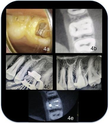Fig: 4a. Clinical image showing 6 canal orifices, 4b.CBCT image, 4c. working length determination, 4d. Post-obturation radiograph, 4e. Post obturation CBCT image.