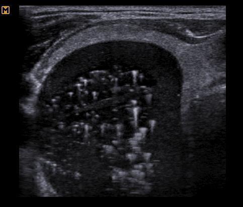 SONOGRAPHIC CHARACTERISTICS ECHOGENIC FOCI NONE, OR LARGE COMET-TAIL