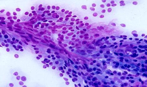 Hurthle cell adenoma Hurthle cell carcinoma Cytologic Features of Hurthle Cell Neoplasms: Pure