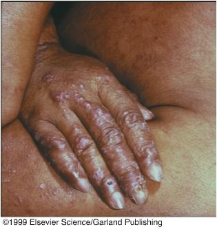 Clinical Vignette DTH Reactions, from Rosen and Geha, Case Studies in Immunology Case 48 Lepromatous Leprosy Ursula Iguaran has