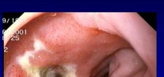 Pathophysiology Normal Gastric Mucosa