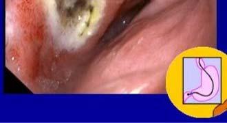 Duodenitis Duodenal Ulcer Gastric