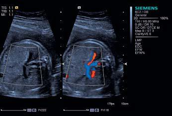 [F] Fetal intra-abdominal vessels are clearly delineated using Clarify