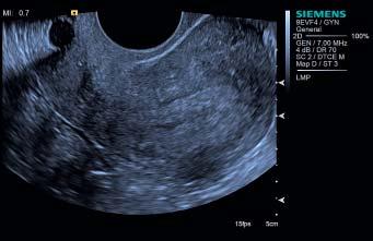 fetal heart using the 6C2 transducer.