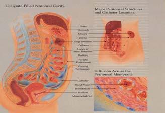 Assessment of the Peritoneal Membrane: Practice Workshop Marina Villano, MSN, RN, CNN marina.villano@fmc-na.com Objectives Briefly review normal peritoneal physiology including the three pore model.