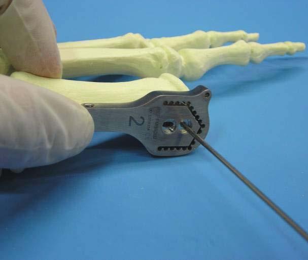 Metatarsal Cutting Guide Mount the appropriate sized Metatarsal Cutting Guide over the k-wire, flush to