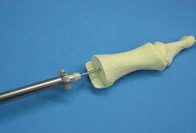 Use the cannulated starter reamer over the kwire.
