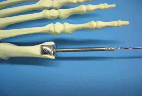 0mm Drill Bit to predrill for the Metatarsal Implant stem