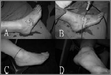 PRE-REQUISITE FOR ARTHROSCOPIC GANGLIONECTOMY IN FOOT AND ANKLE Master the techniques of foot and ankle arthroscopy and endoscopy Accurate