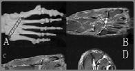MISDIAGNOSIS WRONG APPROACH The apparent high risk of the recurrence of intercuneiform joint ganglion was due its rarity and the one incident of