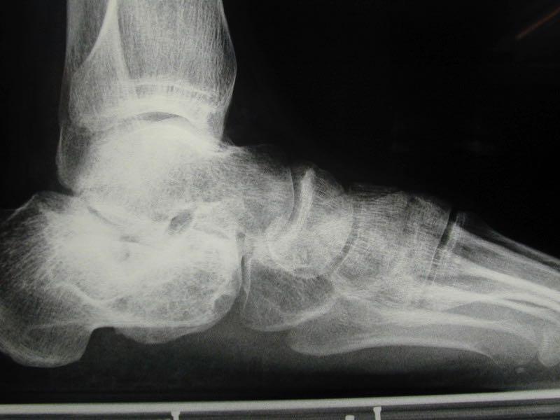 OUTCOME OF CALCANEAL FRACTURE Reduction of calcaneous high Reduction