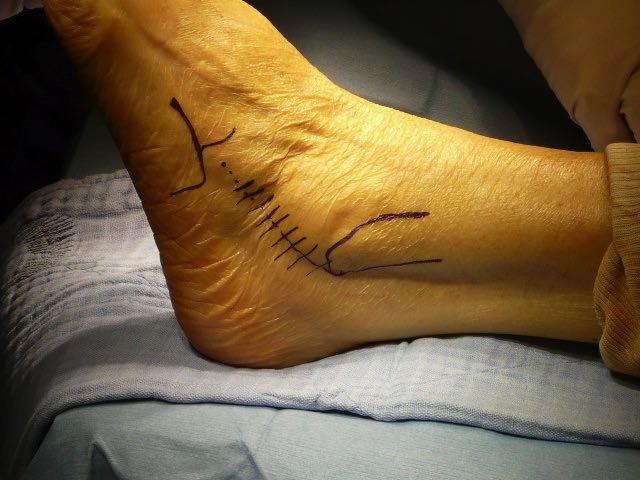 SURGICAL TECHNIQUE : 1 Step (ST +/- CC) - Lateral incision (tip fibula to base MT4) - Sural nerve