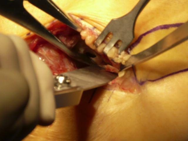 Remove articular cartilage