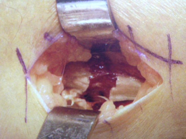 lengthening Transverse incision fascia
