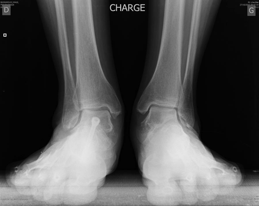 valgus deformity due to the insuffiency