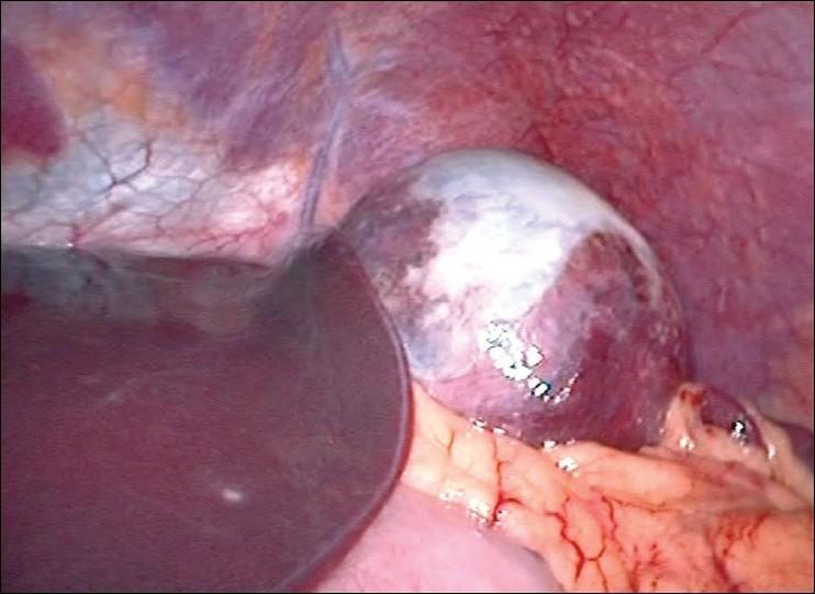 SPLENIC CYSTS Rare clinical entity with approximately 800 case reports worldwide The most common causes are parasitic infections, congenital cysts, and post traumatic cysts They are usually