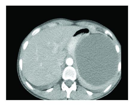 An example of a splenic cyst as seen on CT scan. This image is from a 26-year-old female.