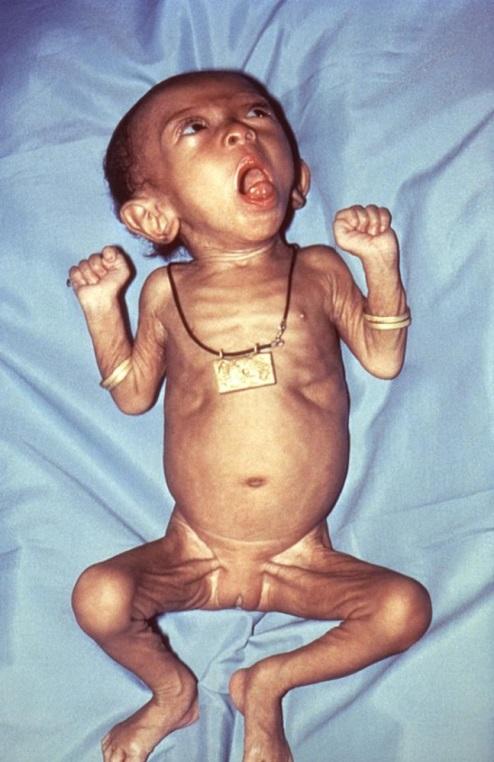 Prevent disease in infants Infants are at highest risk for morbidity Misegades LK, et al.