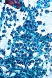 The Bethesda System For Reporting Thyroid Cytopathology Towards a Uniform Terminology With Management Guidelines NCI Thyroid FNA State of the Science Conference