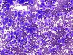 Cell Type / Follicular Neoplasm, Hurthle Cell Type