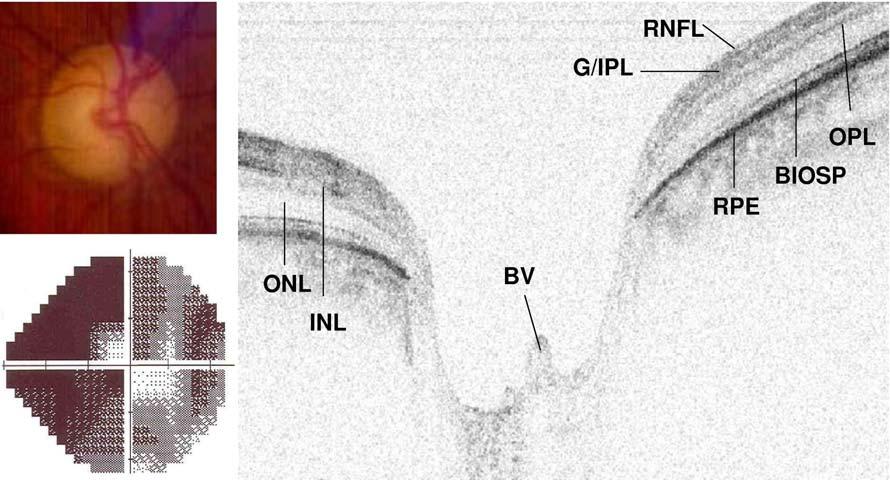 Spectral-Domain Optical Coherence Tomography in Glaucoma with the significant loss of neuroretinal rim tissue seen in the disc photo and the severe constriction of visual field noted on Humphrey