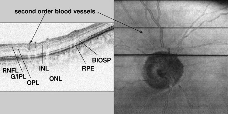 Spectral-Domain Optical Coherence Tomography in Glaucoma FIGURE 8 Spectral domain optical coherence tomography (SDOCT) image of an eye with advanced openangle glaucoma with exposure of second-order