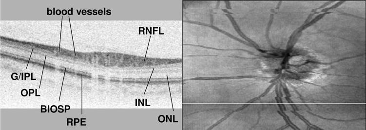 Chen FIGURE 10 Spectral domain optical coherence tomography retinal nerve fiber layer (RNFL) imaging of a normal eye. The left eye of a 49-year-old Caucasian woman is imaged here (normal volunteer A).