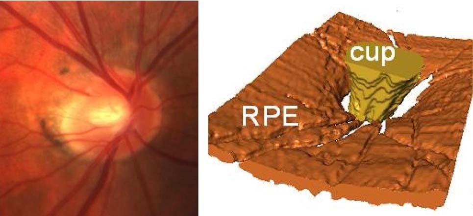 Second-order blood vessels are completely buried within the thick black highly reflective retinal nerve fiber layer.