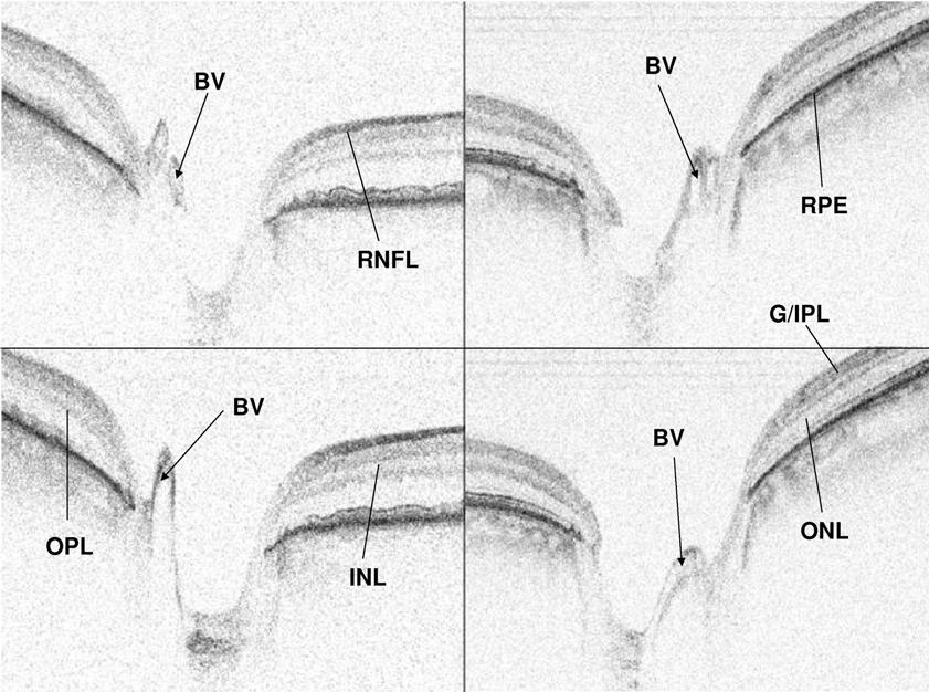 Spectral-Domain Optical Coherence Tomography in Glaucoma FIGURE 15 Montage of select still-images from spectral domain optical coherence tomography videos of patients with glaucoma that demonstrate