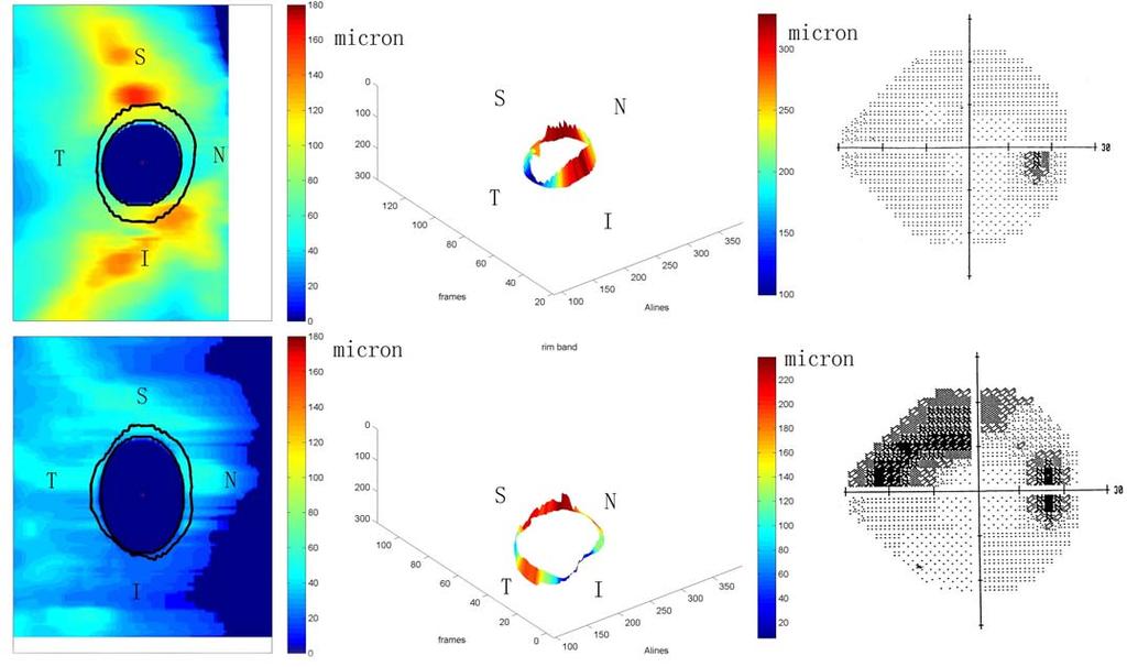 Spectral-Domain Optical Coherence Tomography in Glaucoma Figure 17 illustrates the MDB neuroretinal rim parameter in a normal eye (upper row) and a primary open-angle glaucoma eye (lower row).