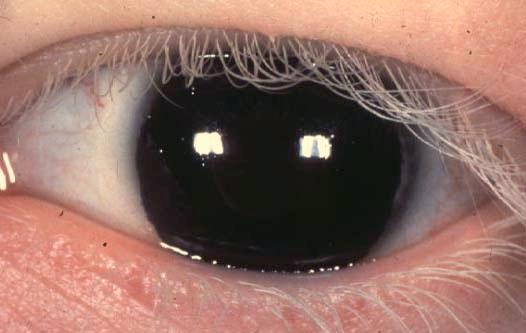 Cosmetic concern Poliosis Def: whitening of eyelashes, loss of pigment of