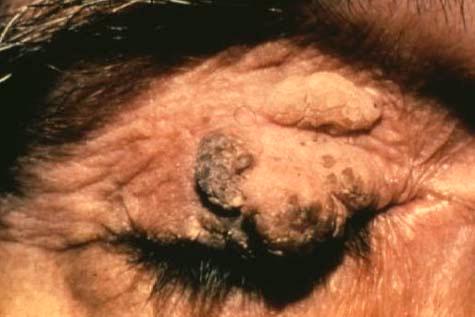 Seborrheic keratosis middle-aged to elderly black-brown, well circumscribed crusty lesion usually slightly elevated with but not inflamed appears stuck on to epidermis Keratoacanthoma rare,