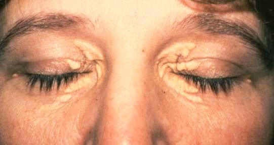 plaques in upper eyelid, most often medially, multiple and often bilateral?