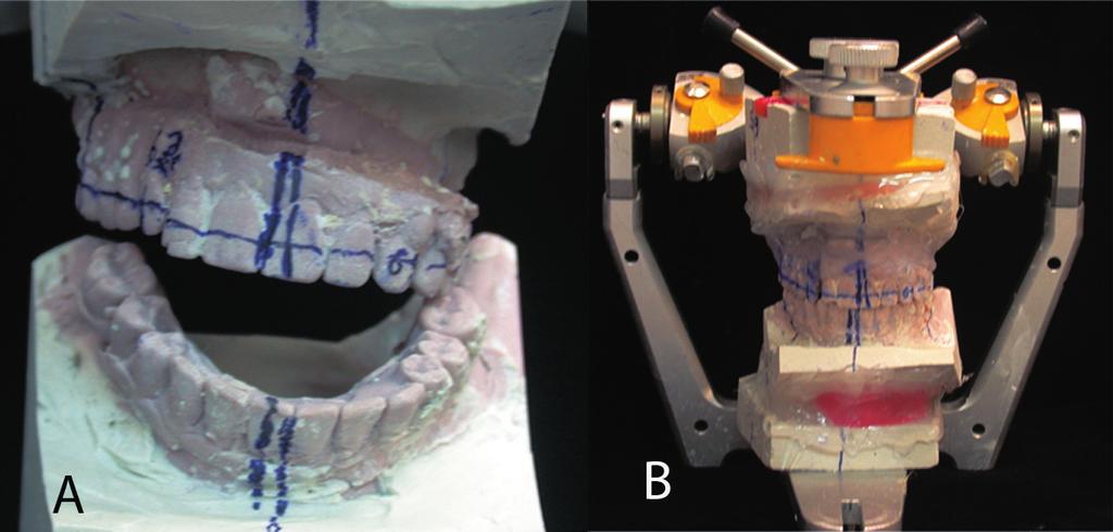 Interrelationship between implant and orthognathic surgery for the rehabilitation of edentulous cleft palate patients: a case report Figure 5- Casts