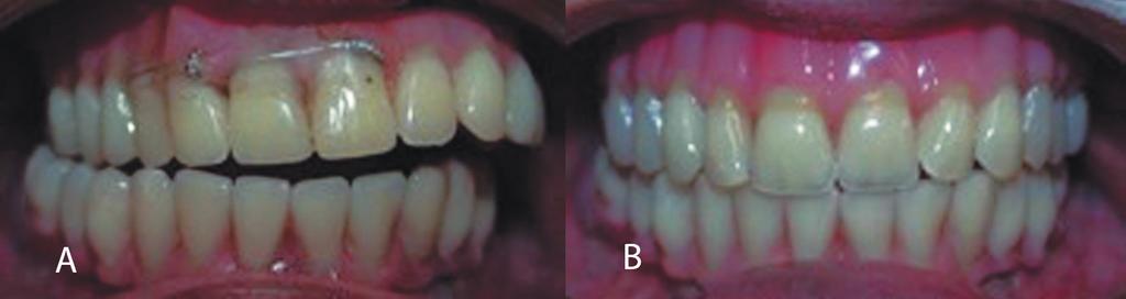 (A), and case concluded, with a correct maxillomandibular relationship (B) Figure 7- Two years later, lateral (A) and frontal view (B) DISCUSSION